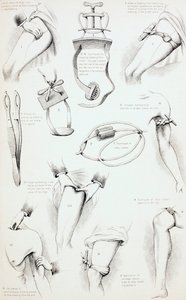 Methoden om Bloeden te Stoppen, ca. 1890