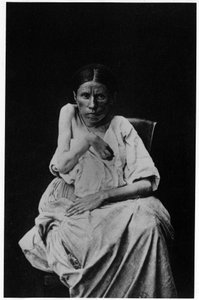 Foto van een patiënt met hemiplegische epilepsie, in "fotografische iconografie van de Salpetrière, Bourneville en P. Regnard, Parijs" door French Photographer