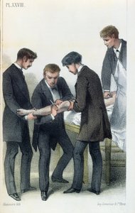 Amputatie van een arm, uit een medisch handboek door Jean-Baptiste-Leon Dubreuil, ca. 1850-60