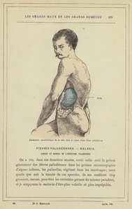 Kenmerkende zwelling van de milt tijdens een malaria-koorts door French School