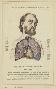 Kenmerkende laesies van bronchitis en bronchiale dilatatie door French School