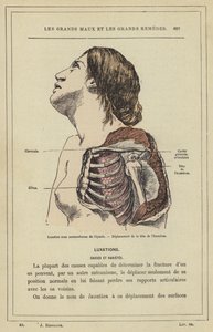 Luxatie onder het coracoïde van de schouder, verplaatsing van de kop van de humerus