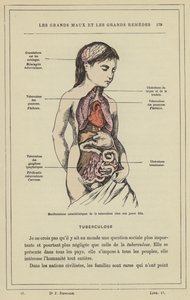 Kenmerkende manifestaties van tuberculose bij een jong meisje door French School