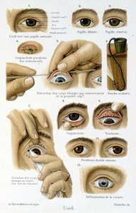 Geneeskunde: het oog door French School