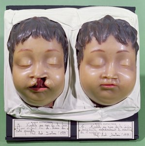 Model dat een kinderlijk gezicht toont voor en na een operatie om een hazenlip te corrigeren uitgevoerd door Antoine Dubois (1756-1837) in 1799 (was) door French School