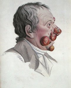 Mycosis Fongoide, uit een boek door Baron Jean Louis Alibert 1838 (gekleurde gravure)