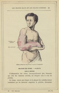 Diepe flebitis van de armaderen in de etteringsfase