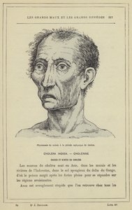 Gezicht van de patiënt in de verstikkingsfase van cholera