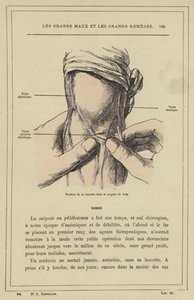 Positie van de lancet in de aderlating van de arm