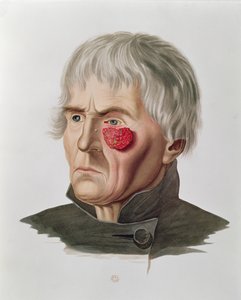Huidaandoening voor een operatie, uit Selecta Praxis Medico-Chirurgica door Alexander Auvert, Parijs, 1856