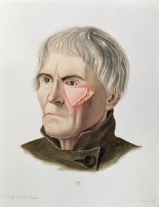 Huidtransplantatie operatie, uit Selecta Praxis Medico-Chirurgica door Alexander Auvert, Parijs, 1856