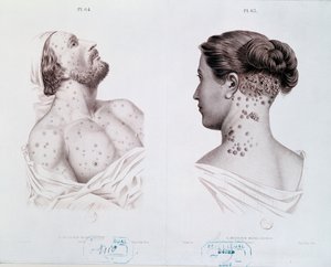 Symptomen van syfilis bij mannen en vrouwen, uit een medisch boek, c.1850-60