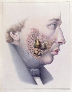 De gezichtsverschijnselen van geslachtsziekten, uit Traite Complet des Maladies Veneriennes door Philippe Ricord (1800-89) 1851