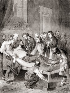 De eerste openbare demonstratie van het gebruik van ingeademde ether als chirurgisch anestheticum in 1846 door een Amerikaanse tandarts, William Thomas Green Morton, uit 