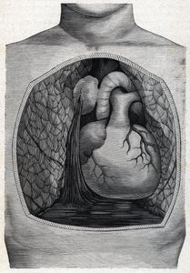 Aneurysma ruptuur, 1888 door French School