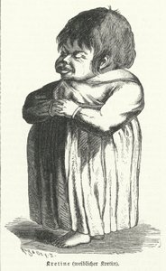 Kretin, vrouw die lijdt aan aangeboren jodiumtekortsyndroom (gravure) door German School