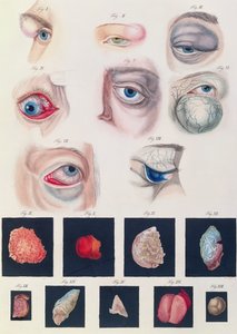 Beschrijving van aangeboren oogafwijkingen, uit Klinische Darstellungen der Krankheiten und Blidungsfehler des Mesnschlichen Auges, door Friedrich August von Ammon (1799-1861) 1838 door German School