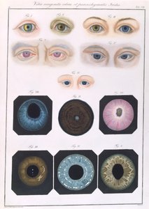 Beschrijving van aangeboren oogafwijkingen, uit Klinische Darstellungen der Krankheiten und Blidungsfehler des Menschlichen Auges, door Friedrich August von Ammon, 1838 door German School