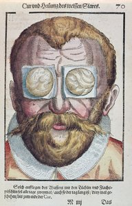 Behandeling van een oogkwaal, uit Ophthalmodouleia door Georg Bartisch, gepubliceerd in Dresden in 1583 door German School