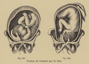 Draaien van een baby in de baarmoeder zodat het hoofd naar beneden wijst voor de geboorte