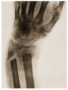 Röntgenfoto van een Gebroken Pols, ca. 1890