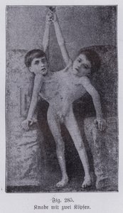 Giacomo en Giovanni Battista Tocci, Italiaanse Siamese tweeling