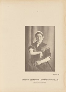 Cerebrale atrofie: Partiële epilepsie Hemiplegie rechts door Paul Marie Léon Regnard