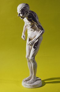 Beeld van een vrouw met de ziekte van Parkinson door Paul Marie Louis Pierre Richer