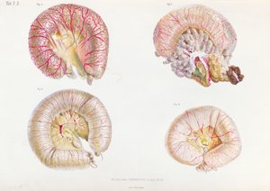 Het externe oppervlak van de darmen geïnfecteerd met cholera, uit Anatomie Pathologique du Cholera Morbus, door Nikolai Ivanovich Pirogov, gepubliceerd in St. Petersburg, 1849