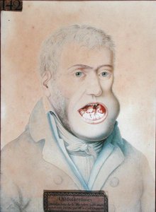 Osteosarcoom van de onderkaak, succesvol geopereerd door Guillaume Dupuytren (potlood op papier)