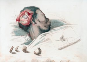 Zicht op wond in schedel na trepanatie en verwijdering van verbrijzeld botstuk linksonder, 1821