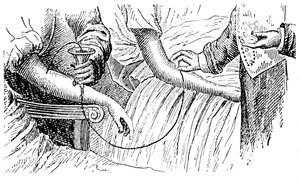 Bloedtransfusie, ca. 1880 door Unbekannt