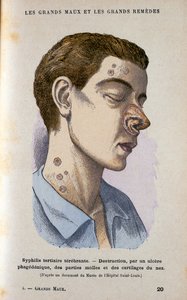 Symptomen van de tertiaire fase van syfilis