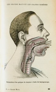 Gebruik van een laryngoscoop om een poliep uit de keel te verwijderen, ca. 1890 door Unbekannt