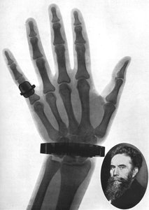 Röntgenfoto van een hand, 1926