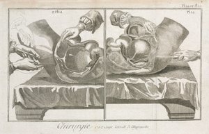Vroege moderne buikchirurgie