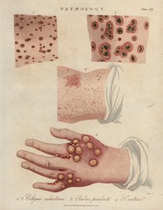 Huidzweer, etterige schurft en schurft veroorzaakt door een scabiei sarcoptische mijt - Lithografie door John Pass, gepubliceerd in Encyclopedia Londinensis door John Wilkes, J.Adlard editie, Londen