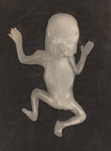 Ossificatiegraad van een vijf maanden oude foetus