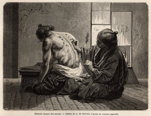 Een dokter die moxa
