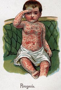 Kinderziekten: Mazelen. In "De nieuwe natuurlijke geneeskunde" door F.E. Bilz.
