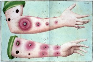 Symptomen van de pokkenziekte die een uitbraak van puisten op de huid veroorzaken. Medische plaat uit het “Vaccinatieverdrag” door Luigi Sacco, Milaan