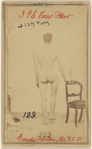 Breuk van het bovenste derde deel van het dijbeen. Erastus Worthen, Corp Co. B. 2nd Vermont Vols. 25 jaar oud - Woonplaats Stockbridge VT. door Unknown artist