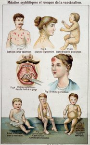 Plaat die de verschillende vormen van syfilitische ziekten en de gevaren van vaccinatie illustreert - in Bilz natuurlijke geneeskunde, eind 19e eeuw