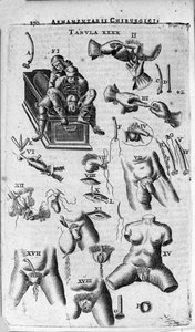 Chirurgische ingrepen op de vrouwelijke en mannelijke geslachten. Gravure in 