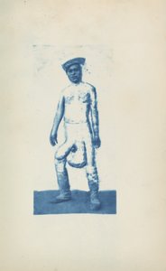 Elefantiasis,ca. 1870 (foto) door Unknown photographer