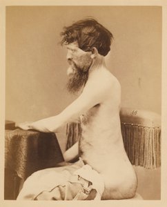 Soldaat John Bar, Herstel na een penetrerende buikwond met breuk van de linker Os Innominatum, uit de fotocatalogus van de chirurgische afdeling