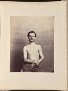 Herstel na excisie van de kop van de linker humerus voor schotwondfractuur door William H. Bell
