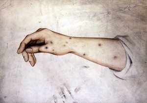Studie van een Onderarm met Huidconditie, ca. 1850 door William Lover