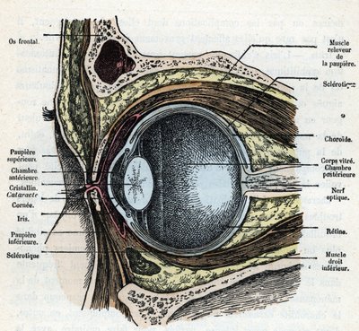 Verticale doorsnede van een oogbal met cataract Gravure uit 