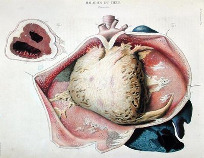 Pericarditis, plaat die hartziekten afbeeldt uit 